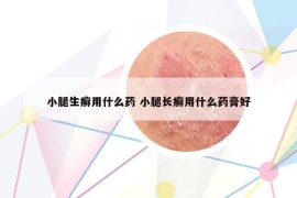 小腿生癣用什么药 小腿长癣用什么药膏好