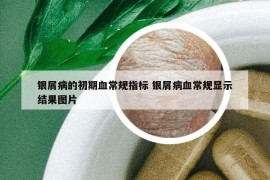银屑病的初期血常规指标 银屑病血常规显示结果图片