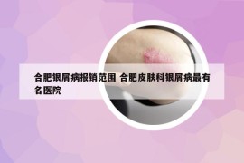 合肥银屑病报销范围 合肥皮肤科银屑病最有名医院