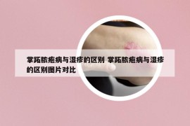 掌跖脓疱病与湿疹的区别 掌跖脓疱病与湿疹的区别图片对比