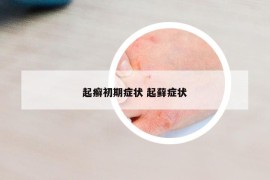 起癣初期症状 起藓症状