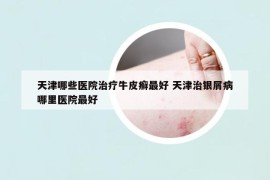 天津哪些医院治疗牛皮癣最好 天津治银屑病哪里医院最好
