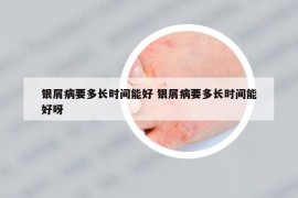 银屑病要多长时间能好 银屑病要多长时间能好呀
