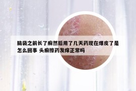 脑袋之前长了癣然后用了几天药现在爆皮了是怎么回事 头癣擦药发痒正常吗