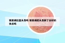 银屑病拉直头发吗 银屑病把头发剃了会好的快点吗