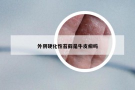 外阴硬化性苔藓是牛皮癣吗