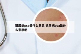 银屑病psa是什么意思 银屑病psa是什么意思啊