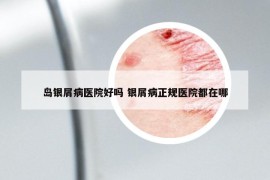 岛银屑病医院好吗 银屑病正规医院都在哪