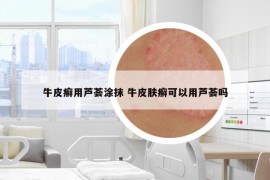 牛皮癣用芦荟涂抹 牛皮肤癣可以用芦荟吗
