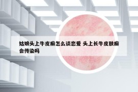 姑娘头上牛皮癣怎么谈恋爱 头上长牛皮肤癣会传染吗