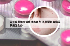 关节炎型银屑病疼痛怎么办 关节型银屑病关节痛怎么办