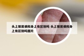 头上银屑病和身上有区别吗 头上银屑病和身上有区别吗图片