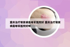 重庆治疗银屑病是哪家医院好 重庆治疗银屑病是哪家医院好呢
