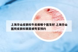 上海华山皮肤科牛皮癣哪个医生好 上海华山医院皮肤科银屑病专家预约