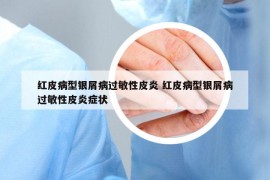 红皮病型银屑病过敏性皮炎 红皮病型银屑病过敏性皮炎症状
