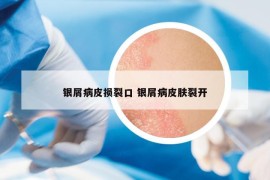 银屑病皮损裂口 银屑病皮肤裂开