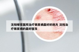 沈阳哪家医院治疗银屑病最好的地方 沈阳治疗银屑病的最好医生