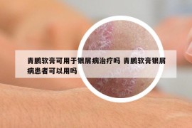 青鹏软膏可用于银屑病治疗吗 青鹏软膏银屑病患者可以用吗