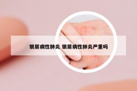 银屑病性肺炎 银屑病性肺炎严重吗