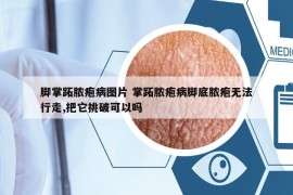 脚掌跖脓疱病图片 掌跖脓疱病脚底脓疱无法行走,把它挑破可以吗