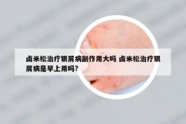 卤米松治疗银屑病副作用大吗 卤米松治疗银屑病是早上用吗?