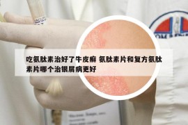 吃氨肽素治好了牛皮癣 氨肽素片和复方氨肽素片哪个治银屑病更好