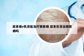 尿素维e乳膏能治疗银屑病 尿素乳膏治银屑病吗