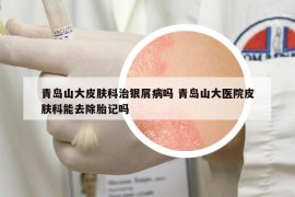 青岛山大皮肤科治银屑病吗 青岛山大医院皮肤科能去除胎记吗