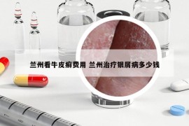 兰州看牛皮癣费用 兰州治疗银屑病多少钱
