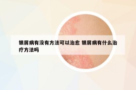 银屑病有没有方法可以治愈 银屑病有什么治疗方法吗