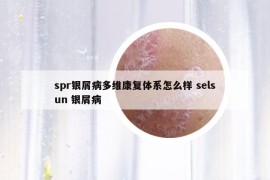spr银屑病多维康复体系怎么样 selsun 银屑病