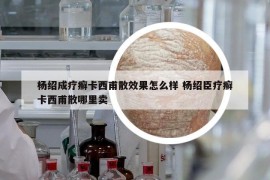 杨绍成疗癣卡西甫散效果怎么样 杨绍臣疗癣卡西甫散哪里卖
