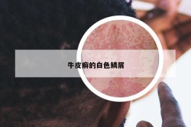 牛皮癣的白色鳞屑