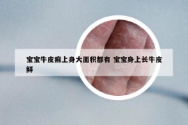 宝宝牛皮癣上身大面积都有 宝宝身上长牛皮鲜