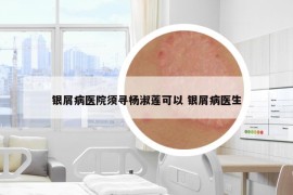 银屑病医院须寻杨淑莲可以 银屑病医生