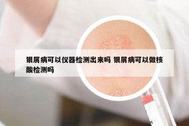 银屑病可以仪器检测出来吗 银屑病可以做核酸检测吗
