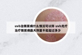 uvb治银屑病什么情况可以停 uvb光疗治疗银屑病最大剂量不能超过多少