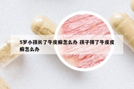 5岁小孩长了牛皮癣怎么办 孩子得了牛皮皮癣怎么办