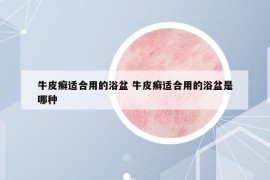 牛皮癣适合用的浴盆 牛皮癣适合用的浴盆是哪种