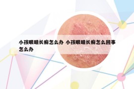 小孩眼睛长癣怎么办 小孩眼睛长癣怎么回事怎么办