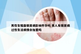 男性生殖器银屑病影响怀孕吗 男人有银屑病过性生活病情会加重吗