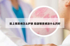 脸上银屑病怎么护肤 脸部银屑病涂什么药好