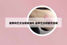 雄黄和巴豆治银屑病吗 雄黄巴豆研磨外搽癣