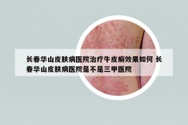 长春华山皮肤病医院治疗牛皮癣效果如何 长春华山皮肤病医院是不是三甲医院