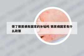 得了银屑病有国家的补贴吗 银屑病国家有什么政策