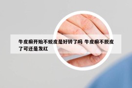 牛皮癣开始不蜕皮是好转了吗 牛皮癣不脱皮了可还是发红