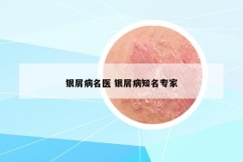 银屑病名医 银屑病知名专家