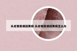 头皮银屑病结黄痂 头皮银屑病结黄痂怎么办