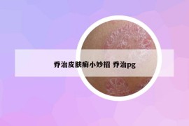 乔治皮肤癣小妙招 乔治pg