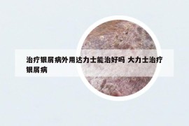 治疗银屑病外用达力士能治好吗 大力士治疗银屑病